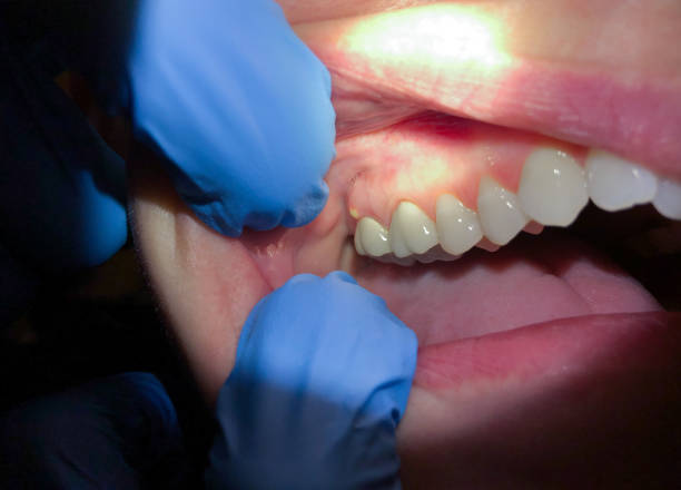 Best Emergency Dental Care for Sports Injuries in Aberdeen, IN