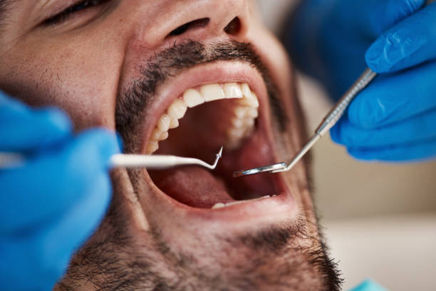 Best Emergency Wisdom Tooth Extraction in Aberdeen, IN